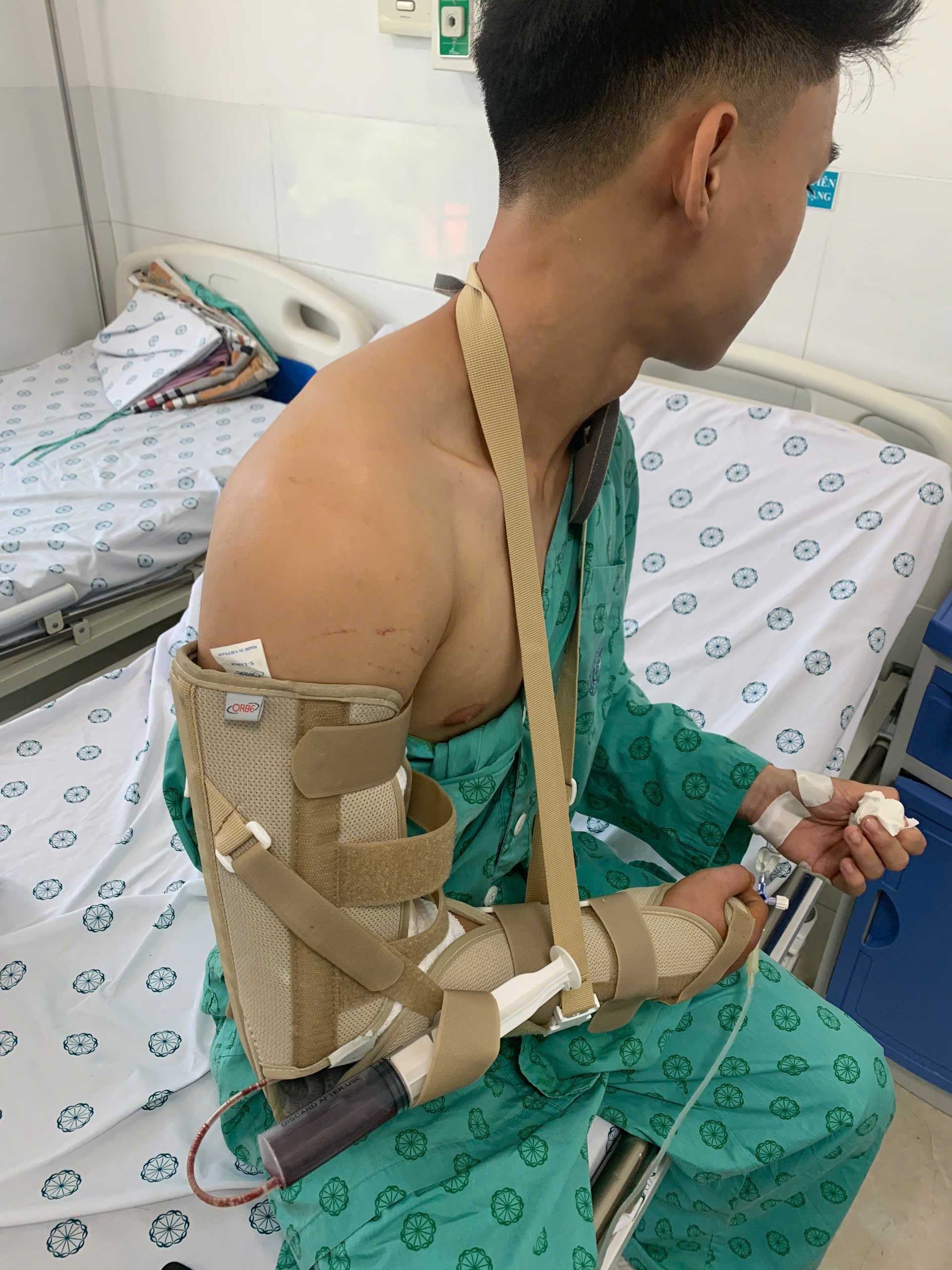 Cảnh báo chỉ với trò chơi “vật tay” nam thanh niên 18 tuổi bị gãy xương cánh tay phải