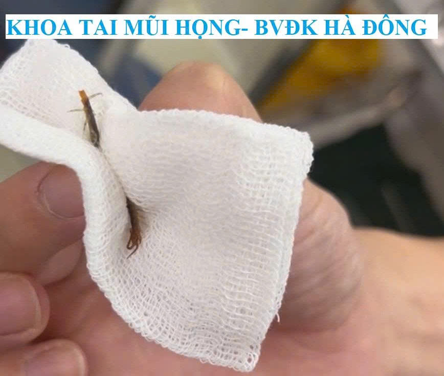 Rết dài 5cm chui vào tai khi đang ngủ