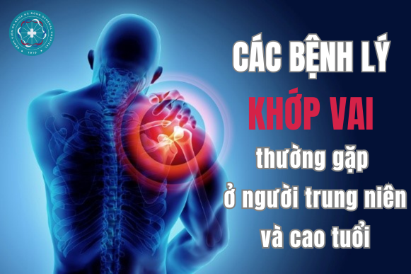 Các bệnh lý khớp vai thường gặp ở người trung niên và cao tuổi