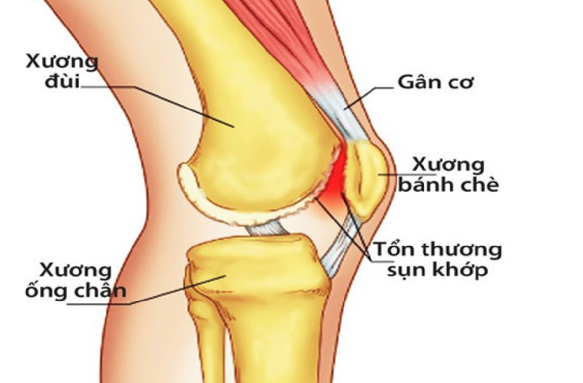 Hiếm gặp: Bệnh lý xương bánh chè hai mảnh cả hai gối