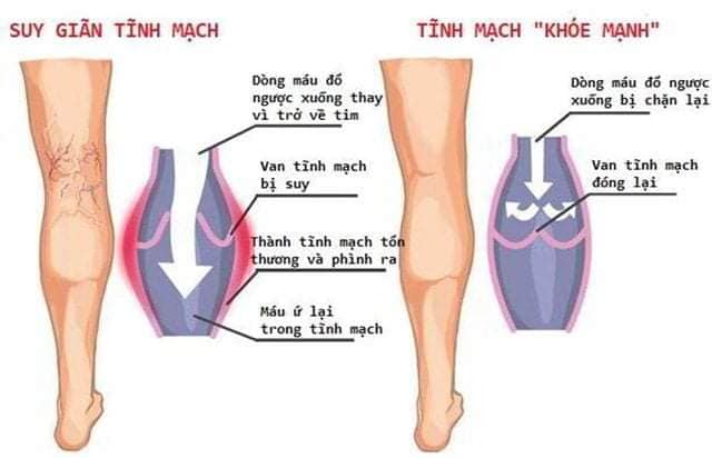  Điều trị suy giãn tĩnh mạch mạn chi dưới bằng phương pháp laser nội mạch 