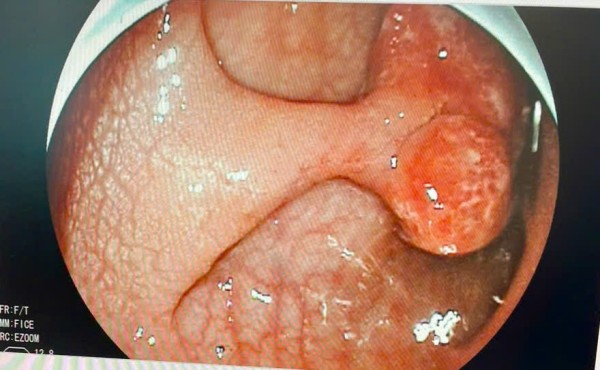 Ca bệnh Nội tiêu hóa