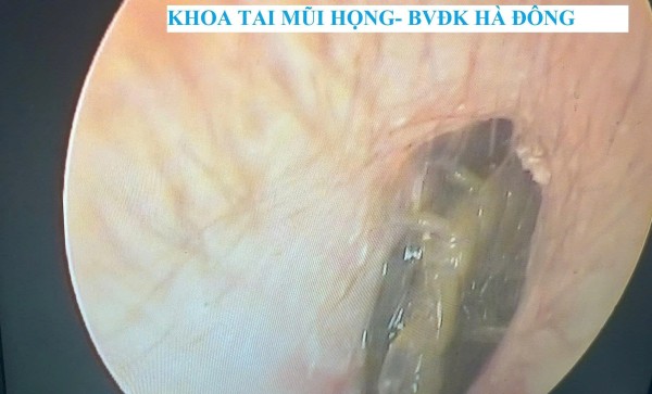 Hy hữu: lấy thành công con rết sống trong ống tai bệnh nhân nam 33 tuổi.