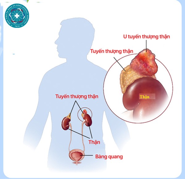 Tiểu hồng tưởng do ăn uống - Nam 19 tuổi phát hiện khối u thượng thận 6cm