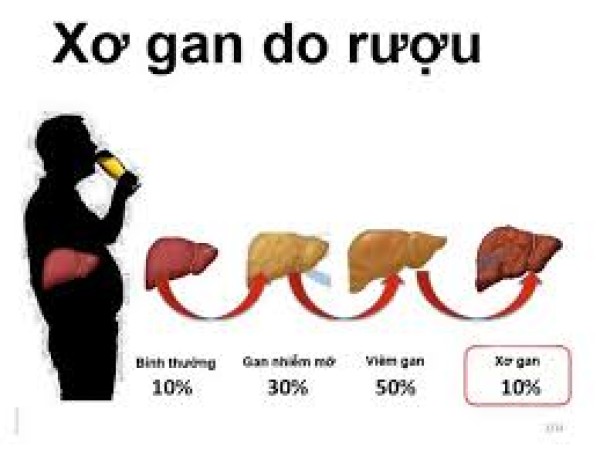 Điều Dưỡng – “Người Giữ Lửa” Trong Hành Trình Hồi Phục Của Bệnh Nhân Xơ Gan Do Rượu