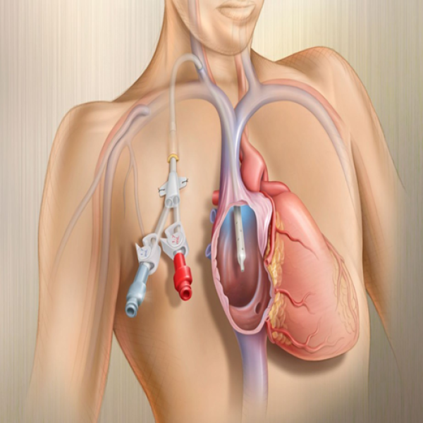 Đặt catheter hai nòng có cuff, tạo đường hầm lọc máu- giải pháp an toàn, hiệu quả cho người bệnh suy thận