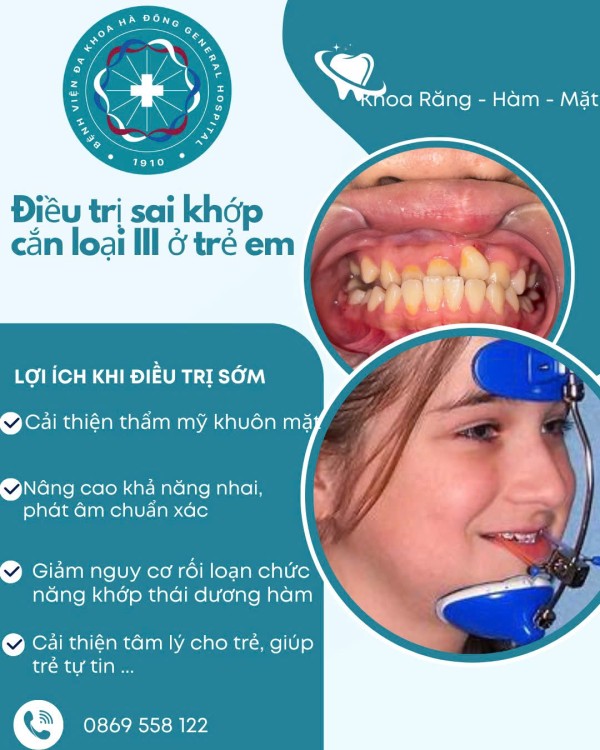 Điều trị sai khớp cắn loại III ở trẻ