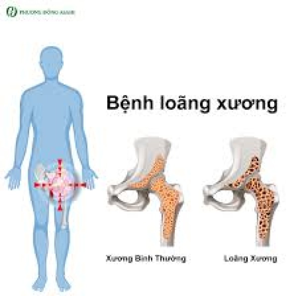 Tăng cường năng lực điêu trị loãng xương tại khoa Nội tổng hợp, chú trọng kỹ thuật, chuyên môn, chăm sóc toàn diện