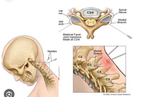 Tiêm cạnh cột sống cổ - giải pháp giảm đau hiệu quả tại BVĐK Hà Đông