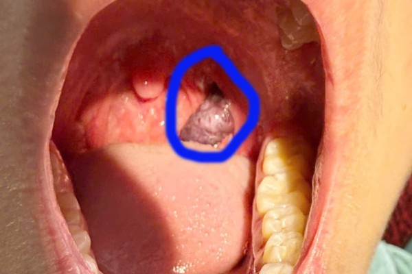 Phẫu thuật thành công lấy khối u máu hiếm gặp trong họng cho bệnh nhi 14 tuổi