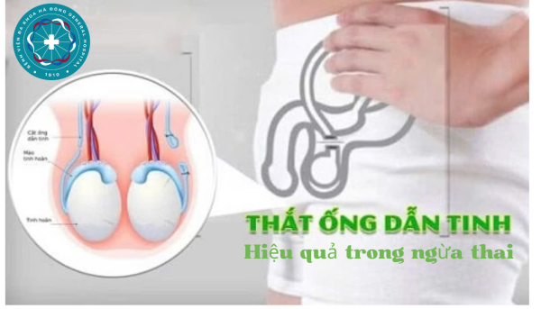 Thắt ống dẫn tinh hiệu quả trong ngừa thai