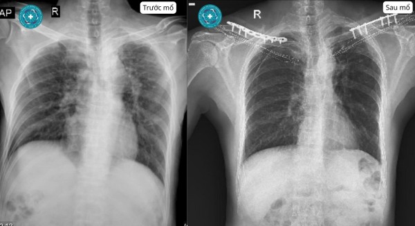 Hi hữu nam bệnh nhân  gãy cùng lúc hai xương đòn sau va chạm xe máy