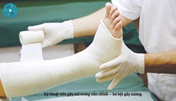 Kỹ thuật tiền gây mê trong nắn chỉnh – bó bột gãy xương