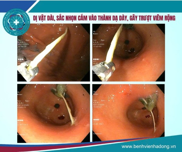 Đau bụng âm ỉ tưởng do ăn uống - nội soi phát hiện dị vật căm sâu trong dạ dày ở phụ nữ 63 tuổi