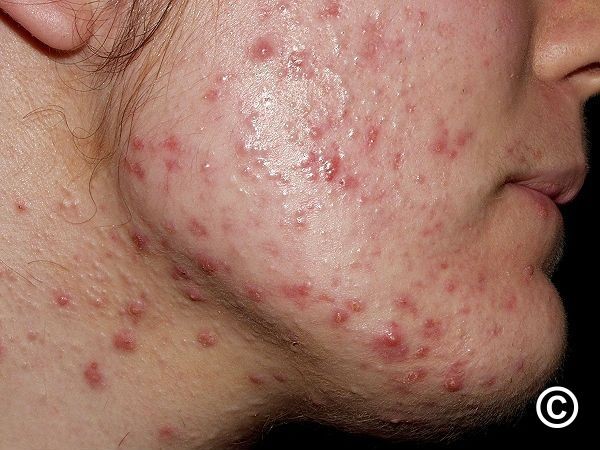 Hiểu đúng về mụn trứng cá để chăm sóc da hiệu quả