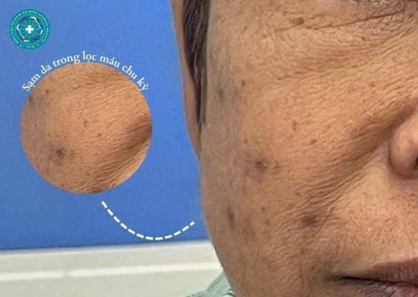 Sạm da trong lọc máu chu kỳ: Hiểu đúng nguyên nhân và giải pháp tối ưu